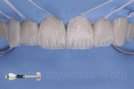 THE #WHITEOLOGY APPROACH_Osama Shalaan_StyleItaliano_ClinicalCase_02 THE #WHITEOLOGY APPROACH_Osama Shalaan_StyleItaliano_ClinicalCase_02
