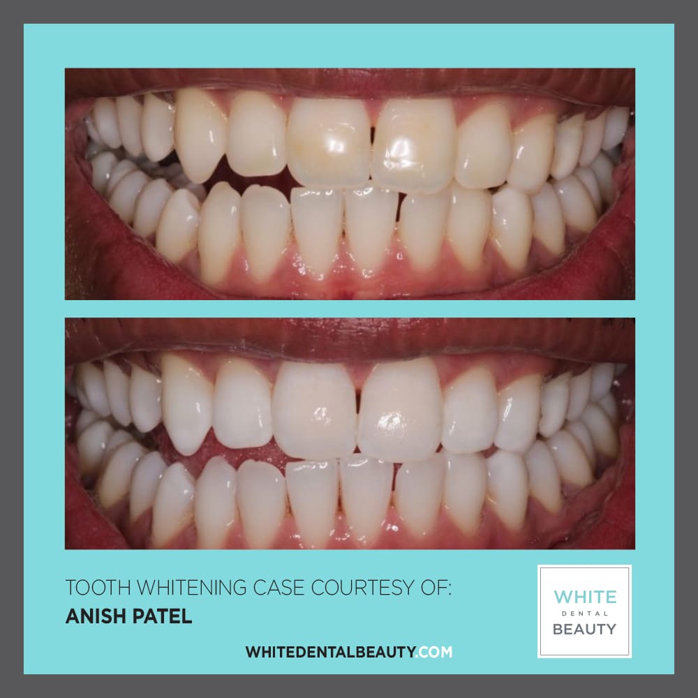 anish patel clinical case white dental beauty