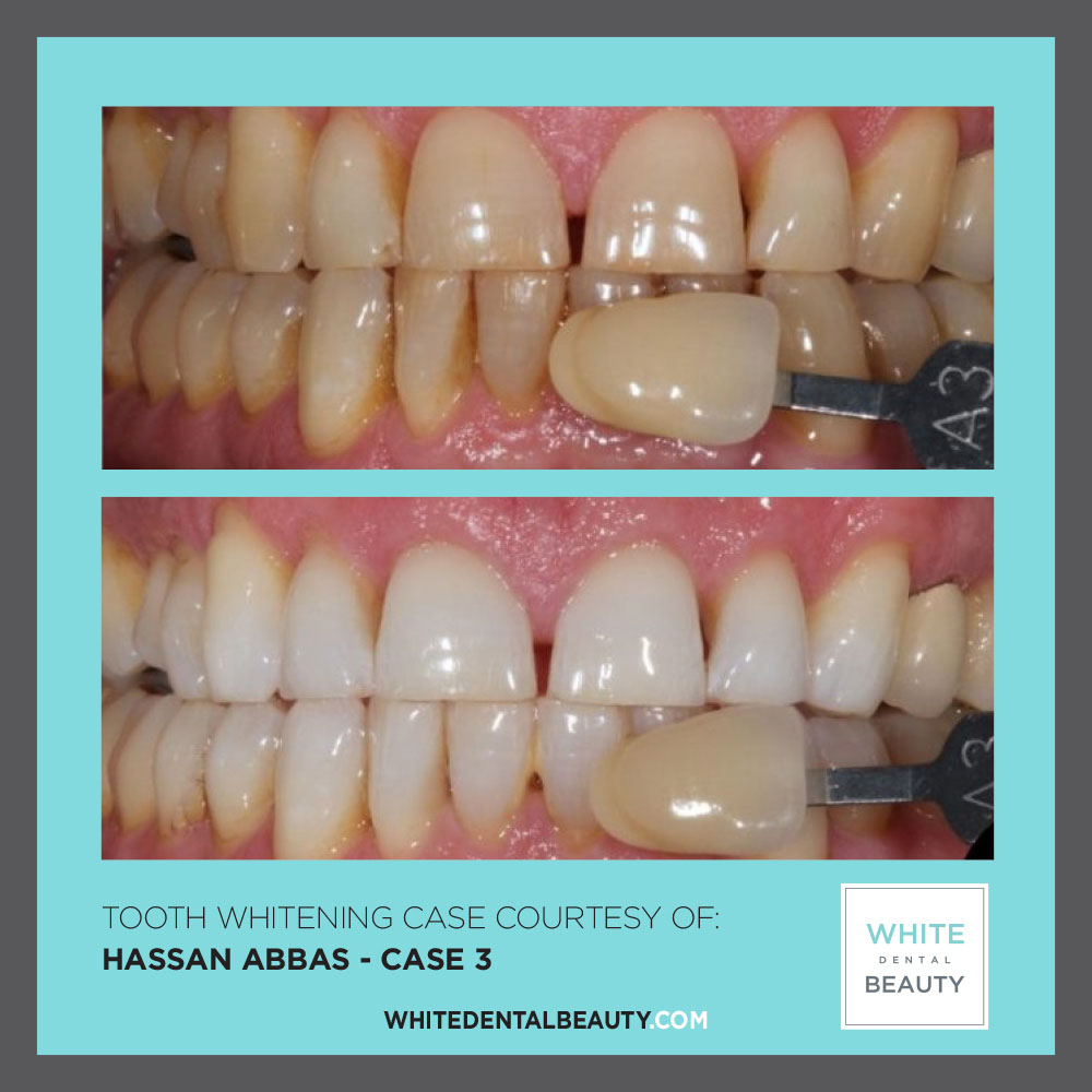 Hassan-Abbas-Case-9