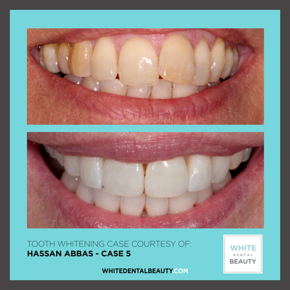 hassan abbas white dental beauty case